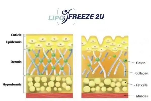 10 Reasons To Choose Advanced RF Microneedling Byfleet