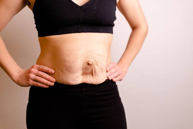 Is Surgery Really the Only Way to Repair Diastasis Recti Byfleet?